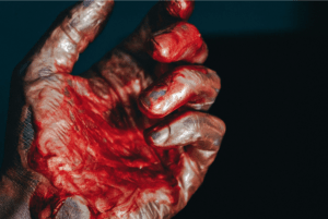 A hand of a burn victim from a hotel fire.